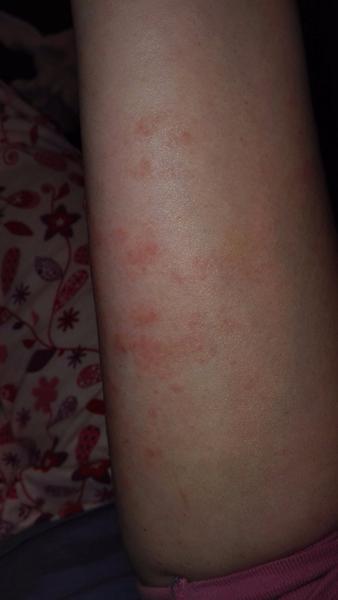 Clostil a hrozné vyrážky na ruke