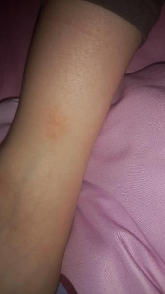 Suché svetlé hnedé fľaky u detí