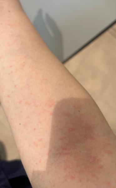 Môže byť vyrážka prejavom alergie?