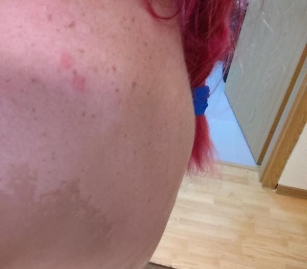 Čo spôsobilo vyrážky po návrate z Turecka?