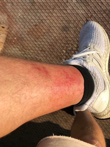 Vyrážky a po nanesení krému opuch