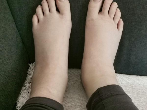 Čo pomôáha na opuch nôh v tehotenstve?