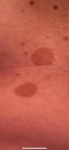 Čo môžu spôsobiť červené fľaky na tele?