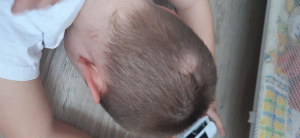 Fľak na hlave a strata vlasov u 6-ročného