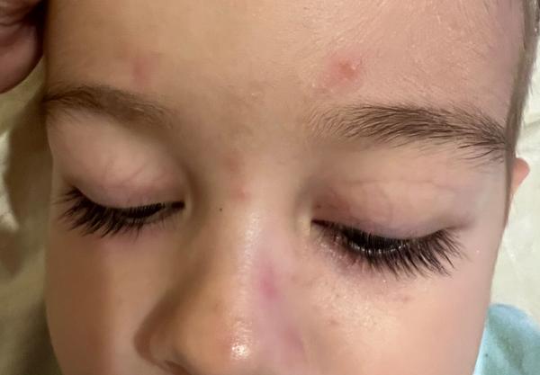 Synovi pribúdajú fľaky na tvári. Sú to kiahne?