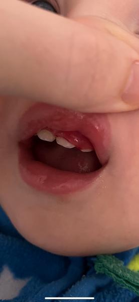 Môžu za opuch a citlivosť ďasien afty na jazyku?