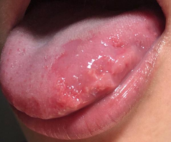 Na jazyku mám nemiznúce lézie. Akého lekára mám ešte navštíviť?