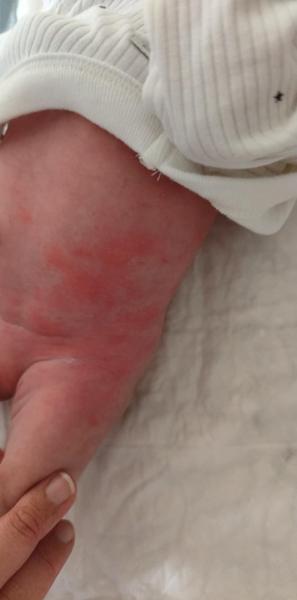 Vyrážky u novorodenca