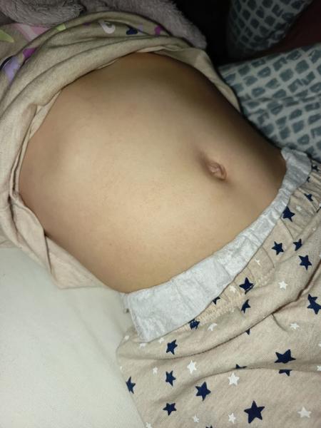 Je to keratóza pilaris?