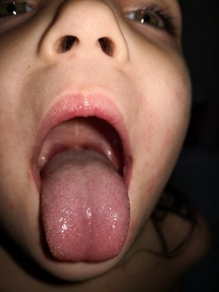 Čo to má moje dieťa vzadu na mandliach, perách a na podnebí?