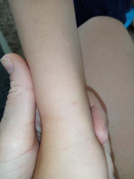 Aké kožné vyrážky má moja 5 ročná dcéra?