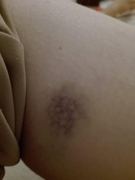 Je to modrina alebo prasknutá žilka?