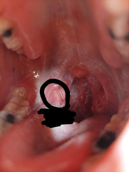 Mám výčnelok na mandli