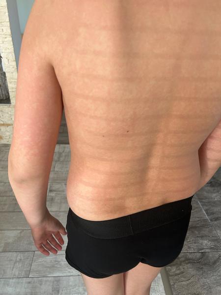 Je to piata choroba alebo osýpky?