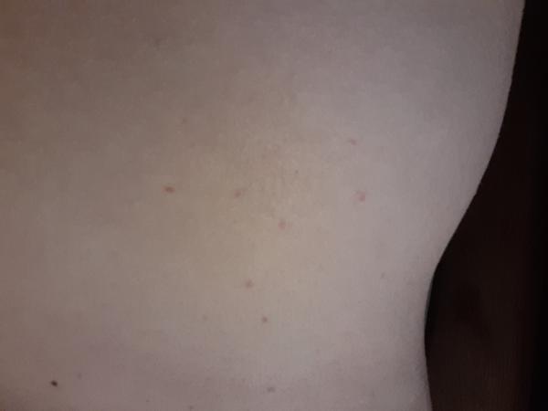 Svrbenie a zvláštna vyrážka v 5tt?