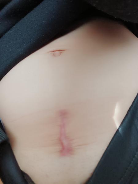 Čo je s jazvou po mojej sekcii?