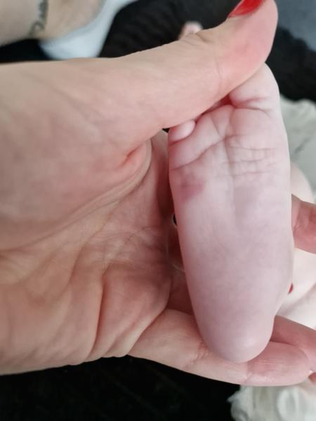 Fľak na chodidle u 2-mesačnej dcérky