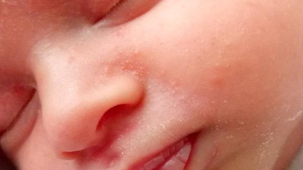 Aké vyrážky to má moje štvortýždňové dieťa?