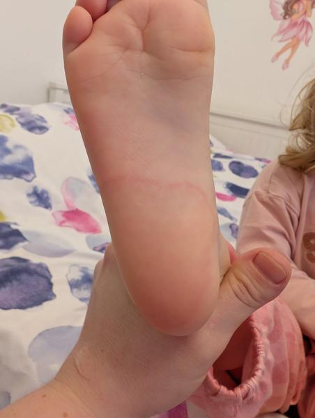 Opakujúce sa vyrážky na nohách trojročného dieťaťa