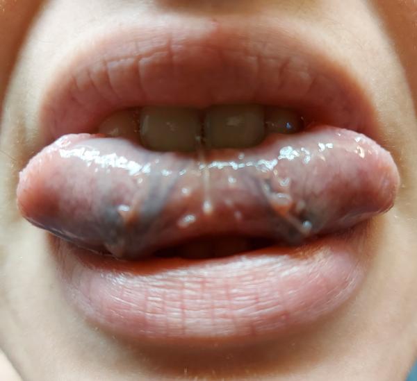 Pod jazykom som si našla výrastky. O aký problém ide a čo mi odporúčate?