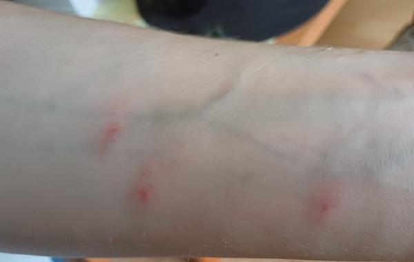 Rozpoznáte blšie štípance na pokožke?