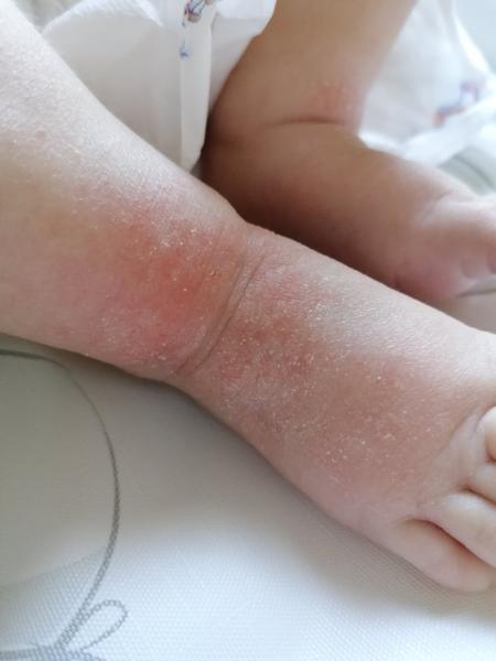 Dcéra máva vysypané nohy po ich šúchaní. Čo mi odporúčate?