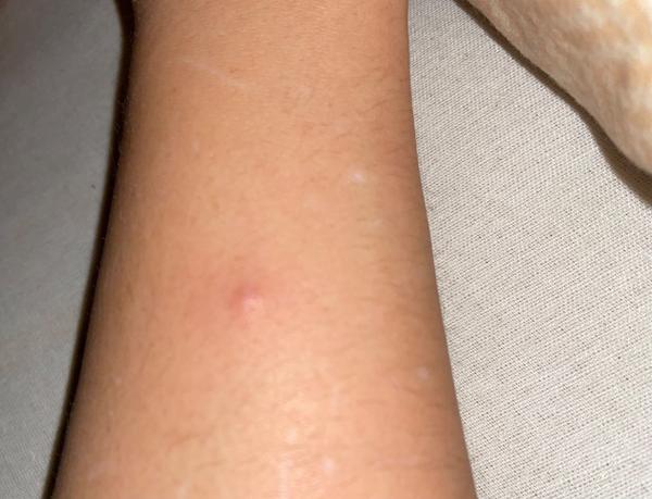 Je kliešť na ruke po troch dňoch bezpečný?