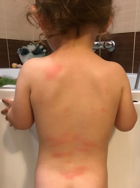 Aké červené fľaky to má dcérka po tele?