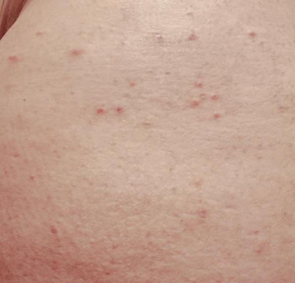 Prečo ma svrbí brucho a prsia?