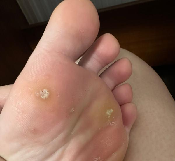 Je to kurie oko alebo bradavica?