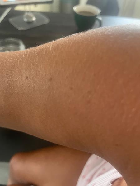 Svrbenie a pluzgiere na pokožke