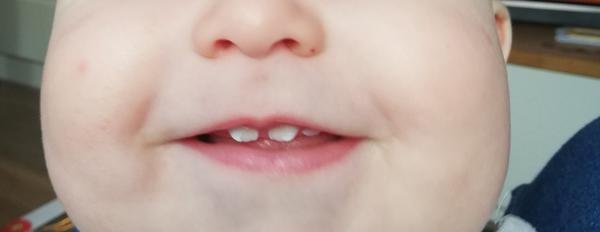 Majú biele fľaky na synových zuboch súvis s užívaním kortikoidov v tehotenstve?