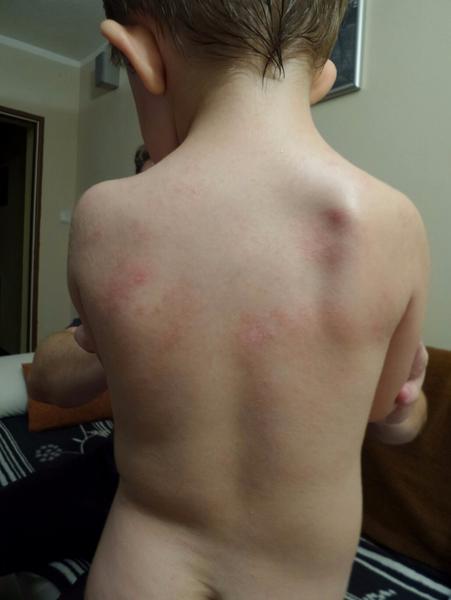 Atopický ekzém u skoro trojročného