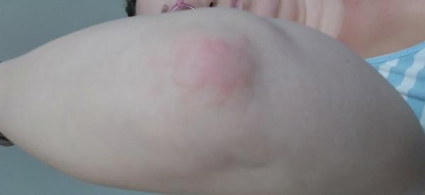 Na tele sa mi objavujú a miznú červené fľaky. Mám psoriázu?