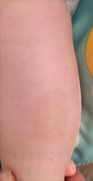 Má môj syn pigmentový fľak?