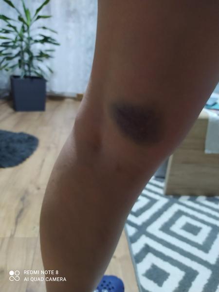 Aká veľká modrá modrina sa mi urobila pod kolenom?