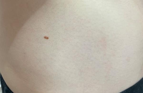 Sú toto strie alebo iný kožný problém?