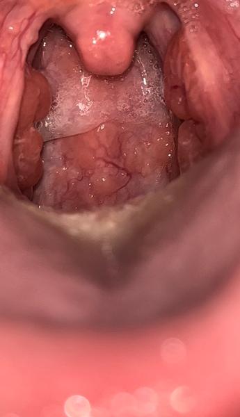 Ako liečiť hlieny zatekajúce do hrdla po prekonaní Covidu-19?