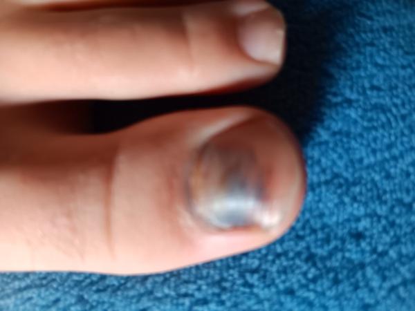 Modriny pod nechtom u dieťaťa