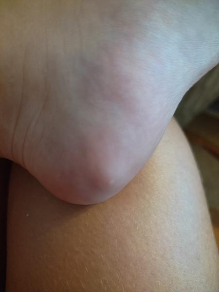 Ako zvládnuť štipnutie na nohe u dieťaťa?