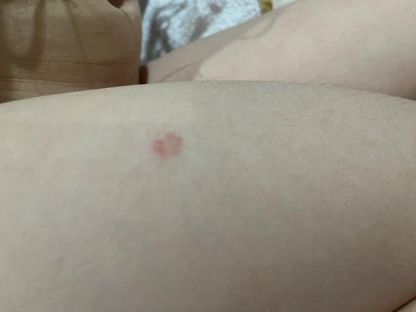 Čo spôsobuje vyrážky u štvorročného dieťaťa?