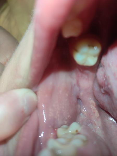 Kedy vyhľadať lekára kvôli fľakom na lícach?