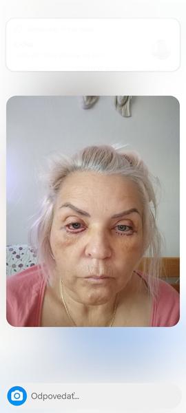 Je operácia viečok bezpečná a čo očakávať?