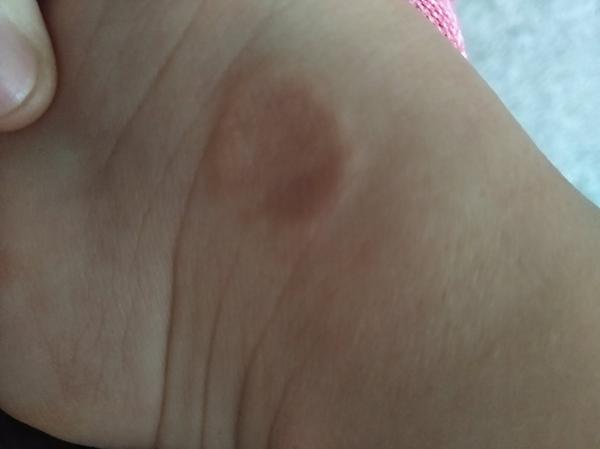 Čo znamenajú podkožné kolieska na nohách trojročnej dcéry?