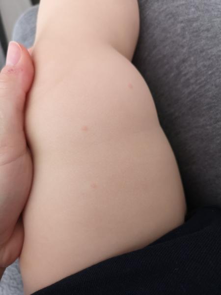 Štípance alebo vyrážky?