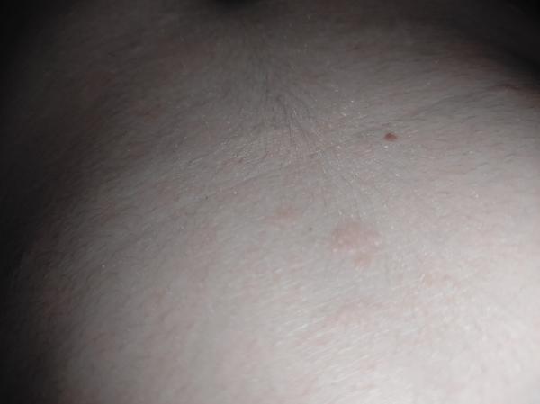 Aké červené fľaky mám na tele?