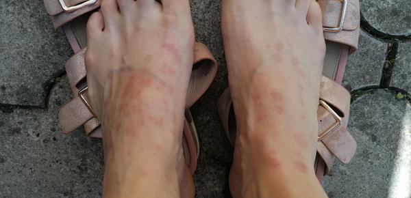 Fľaky na priehlavkoch