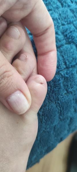 Prečo mám škvrnku pod nechtom?