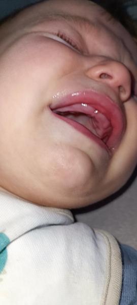 Ako dlho trvá prerezávanie detských zúbkov?