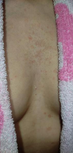 Divné fľaky na dekolte